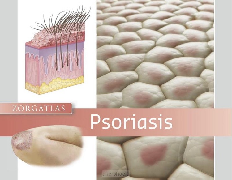 Psoriasis
